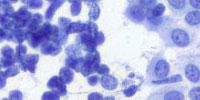 Kidney Cancer Reveals its Weak Link