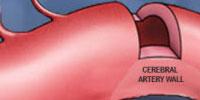 A Tool to Better Screen and Treat Aneurysm Patients