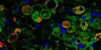 Tuberculosis: Daily Antibiotics Recommended to Prevent Resistant Strains