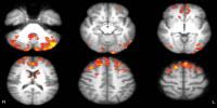 Video Games Improve Brain Connections in Multiple Sclerosis Patients