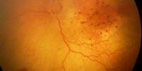 Zika Virus May Be Linked to More Eye Problems in Brazilian Babies with Microcephaly