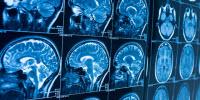 How Can Stress Cause Anxiety? Blame the Brain's Cannabis