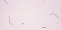 Scientist Makes Groundbreaking Discoveries on the Parasite That Causes River Blindness Disease