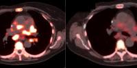 Experts Call for Expansion of Molecular Imaging in Precision Cancer Care