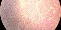 International Study Identifies New Genetic Risk Factors for Testicular Cancer