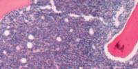 Bolstering Fat Cells Offers Potential New Leukemia Treatment