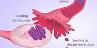 Scientists Track Ovarian Cancers to Site of Origin: Fallopian Tubes