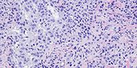 Estrogen-Mimicking Compounds in Foods May Reduce Effectiveness of Breast Cancer Treatment