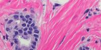 Diet May Influence the Spread of a Deadly Type of Breast Cancer, Study Finds