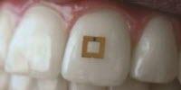 Scientists Develop Tiny Tooth-Mounted Sensors That Can Track What You Eat