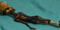 Six-Inch Human Skeleton Discovered with Multiple Disease-Associated Mutations