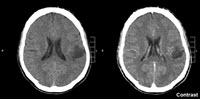 A Targeted Approach to Treating Glioma