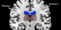 Dehydration Alters Human Brain Shape and Activity, Slackens Task Performance