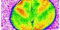 How Cannabis and Cannabis-Based Drugs Harm the Brain