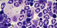 Scientists Close in on Mystery Surrounding Dangerous Blood Syndromes