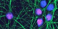 Study: Alzheimer’s Drug May Stop Disease If Used before Symptoms Develop