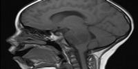The Search for New Targets and Treatments for Pediatric Brain Cancer