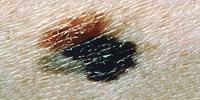 Scientists Test New Cancer Vaccine Against Melanoma