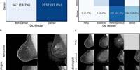 Artificial Intelligence Used in Clinical Practice to Measure Breast Density