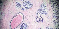 Drug Improves Survival in Metastatic Breast Cancer