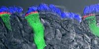 New Cystic Fibrosis Treatments Work Best in Inflamed Airways