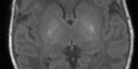 A 15-Minute Scan Could Help Diagnose Brain Damage in Newborns