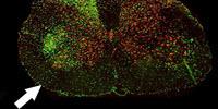 Can a Nerve Injury Trigger ALS?