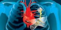 Engineers Harvest Heart’s Energy to Power Life-Saving Devices