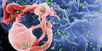HIV Remission Achieved in Second Patient