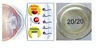 Hydrogel Contact Lens Created to Treat Serious Eye Disease