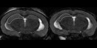 Alzheimer's Disease Protein Links Plaques to Cell Death in Mice