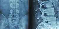 An 'EpiPen' for Spinal Cord Injuries