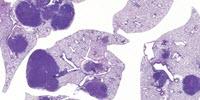 Two Therapeutic Targets Identified for Deadly Lung Cancer