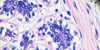 Electromagnetic Fields May Hinder Spread of Breast Cancer Cells