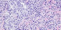 Novel Therapy Studied for Inherited Breast Cancer
