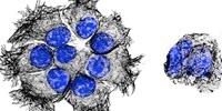 Pancreatic Cancer: Less Toxic, More Enduring Drug May Improve Therapy