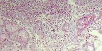 Study Provides First Evidence That Fat Accumulates in the Lungs of Overweight and Obese People