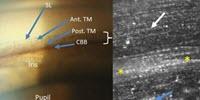 Telescope Technology Used to Take First Accurate Images of Glaucoma-Related Eye Structure