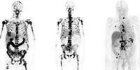 Novel Theranostic Reagent Could Enhance Detection and Therapy of Prostate Cancer