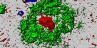 Possible Alzheimer's Breakthrough Suggested